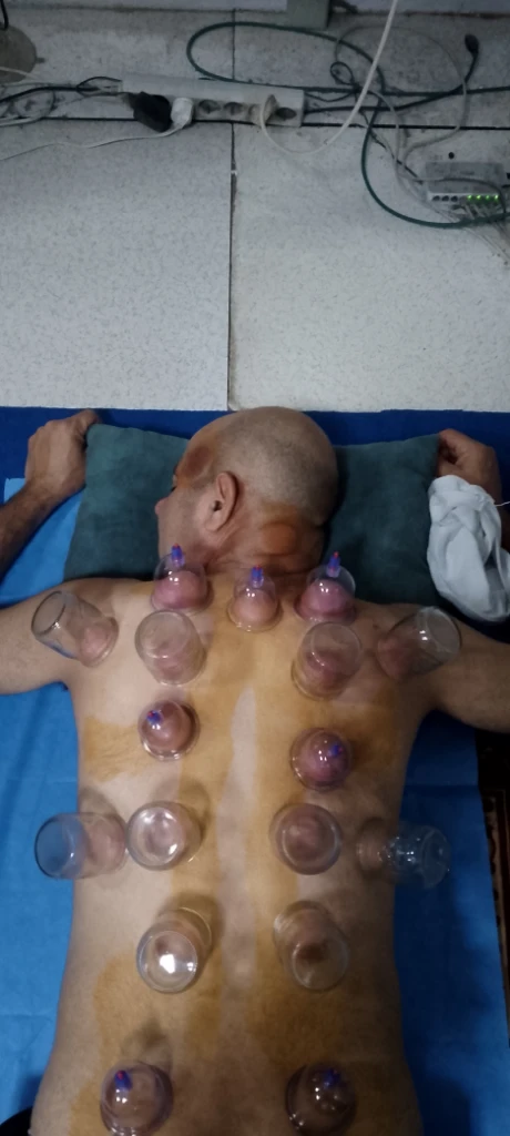 صورة لـ  حجامة طبية …