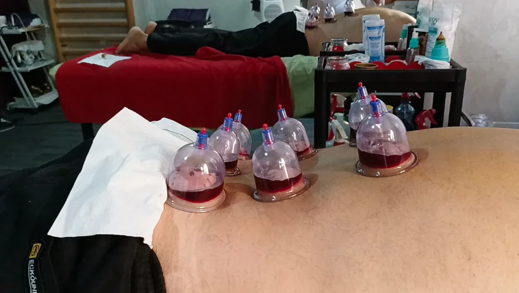 صورة لـ  الحجامة الطبية الرطبة و الجافة