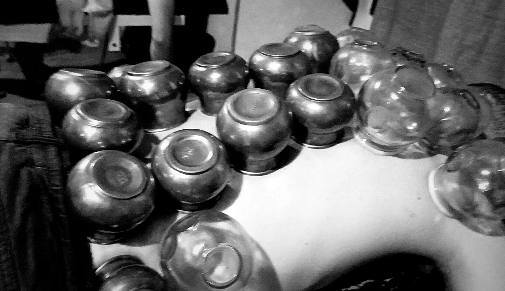 صورة لـ  الحجامة الطبية الرطبة و الجافة