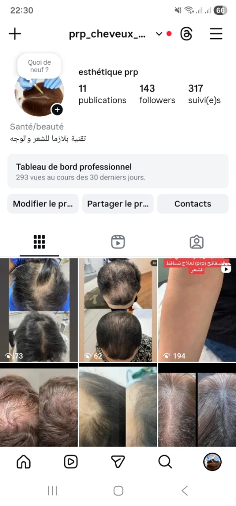 صورة لـ  بلازما للشعر والوجه