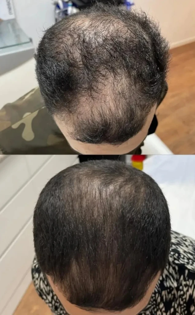 صورة لـ  بلازما للشعر والوجه