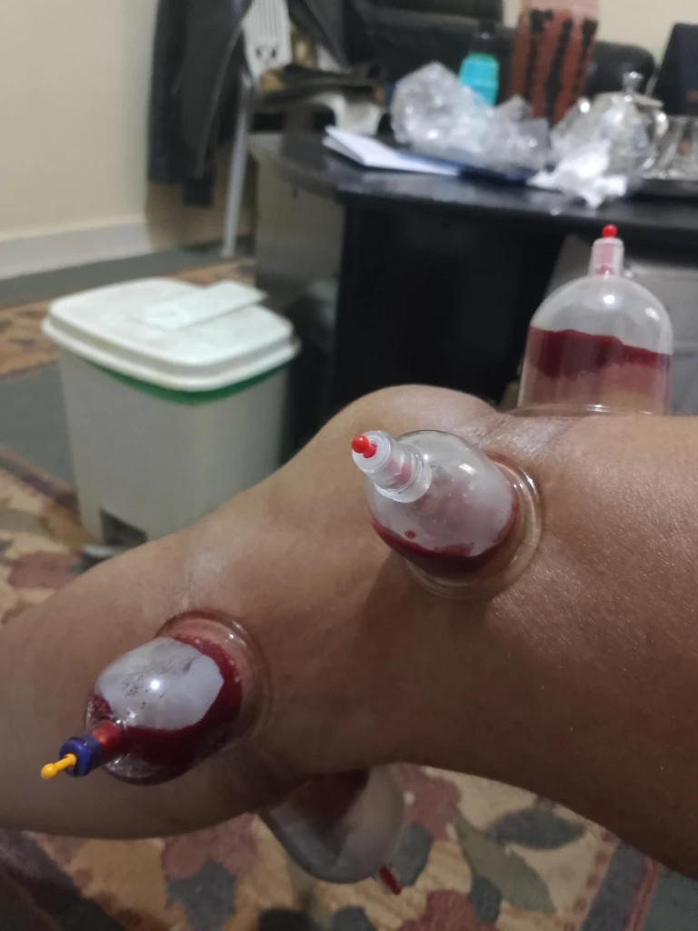 Additional image 5 of الحجامة بكل…
